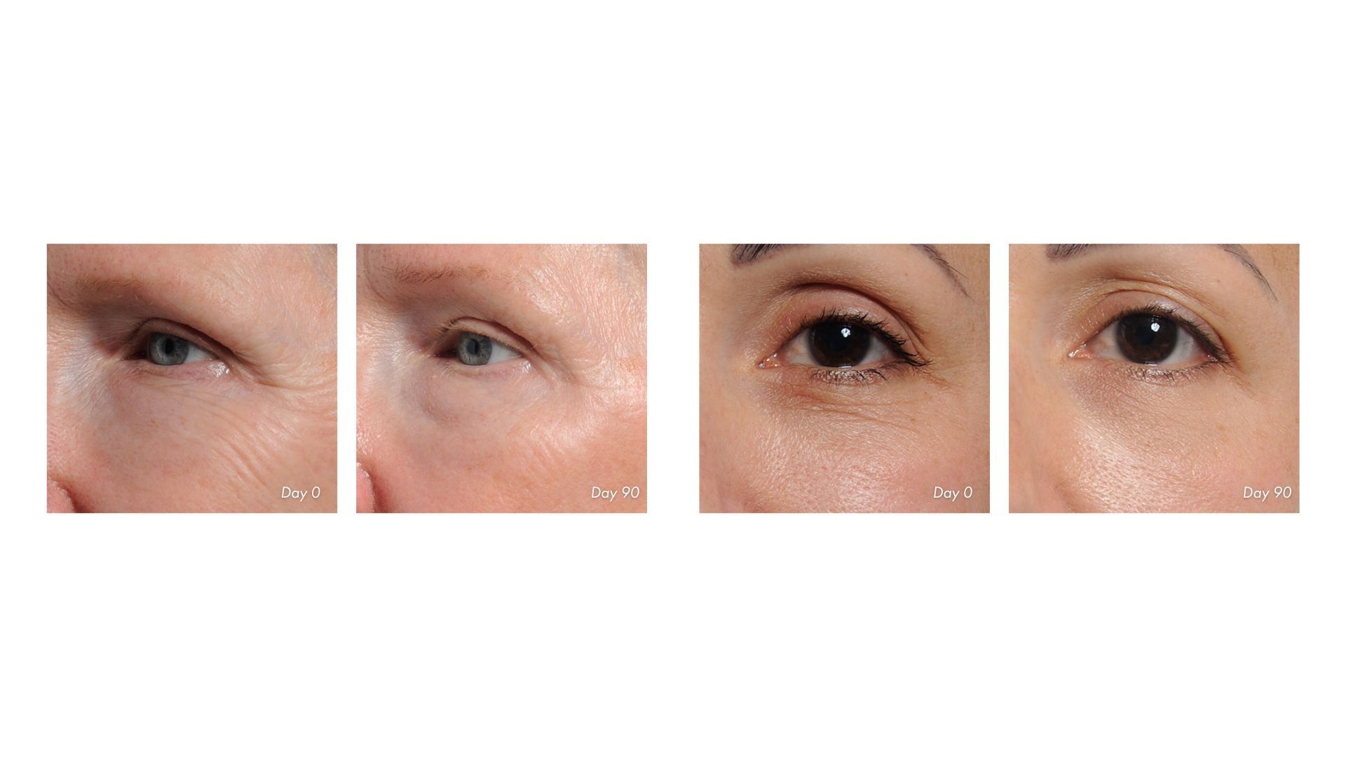 Before-and-after results from using the NIRA Precision Laser around eyes for 90 days