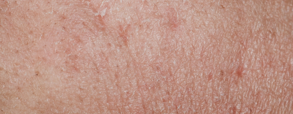 Close-up of flaky, rough skin texture