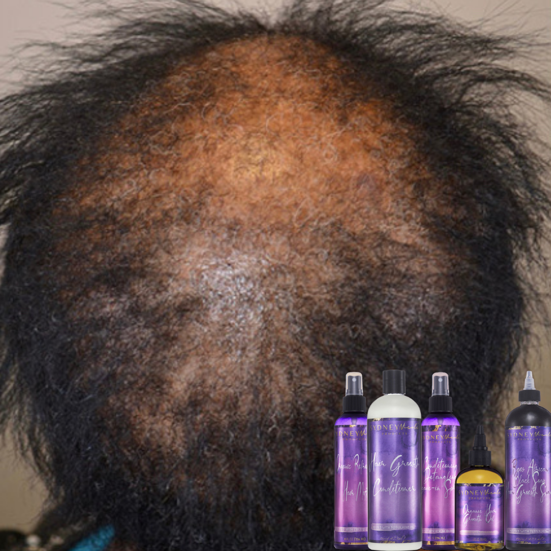 Holistic Hair Loss Treatment