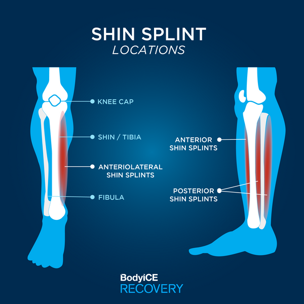 Shin splint locations