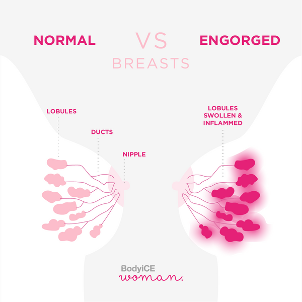 Engorged Breasts Infographic