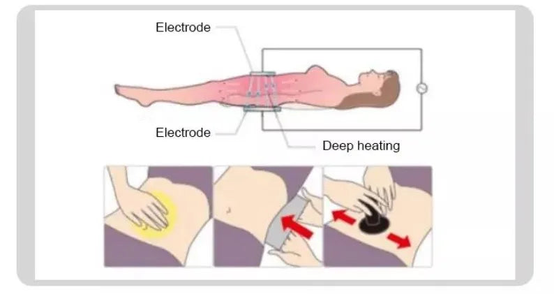 Indiba R45 System RF Deep Beauty Face Lifting & Body Sculpting Machine for Anti-Aging & Cellulite Reduction