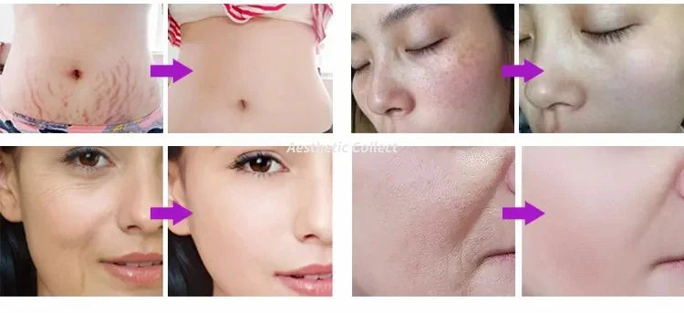 Novoxel Thermal Fractional RF Skin Tightening Machine - Anti-Wrinkle, Skin Rejuvenation, Heat Therapy Technology