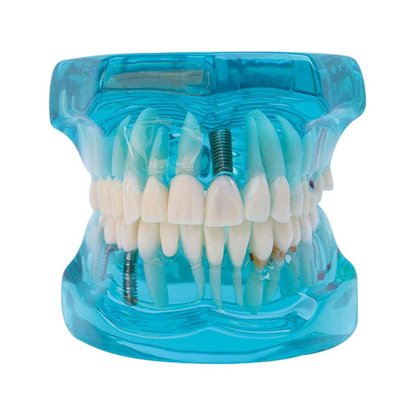 استعادة طب الأسنان مع نموذج الزرع الذي يظهر بعض طرق العلاج: زرع، ماريلاند جسر ثابت، البطانة وغيرها.