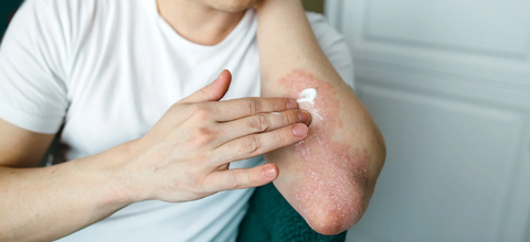 Using creams for psoriasis photo