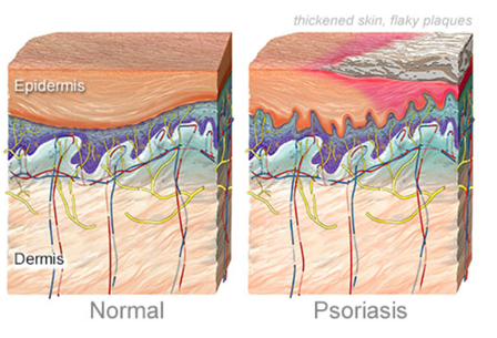 Psoriasis vs normal skin