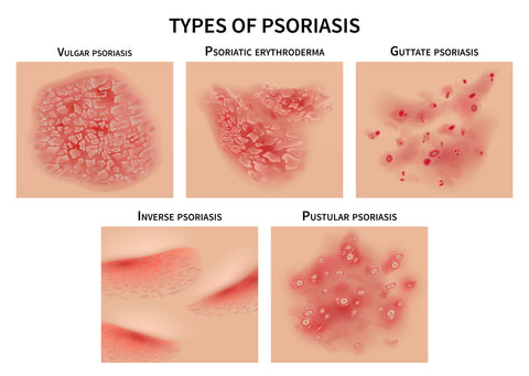 types of Psoriasis