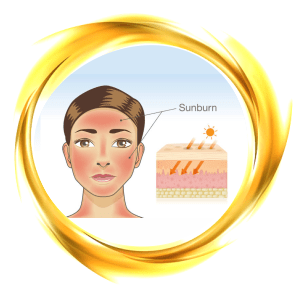 sunburn lotion