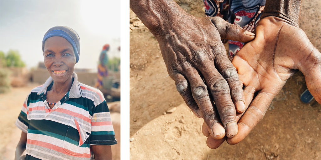 A woman in Niger shows her calloused hands from hauling dirty water out of a deep, open well. | neverthirst in Niger