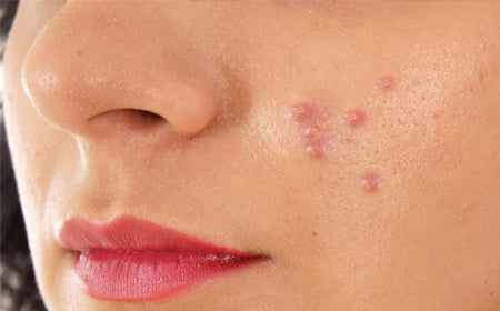 Acne pimples skin