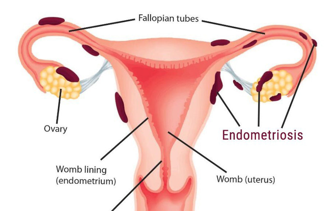 Endometriosis - Gynoveda