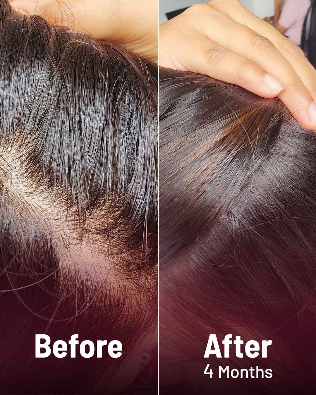 Hair loss treatment Antiandrogens ideal for women with polycystic ovaries   Expresscouk