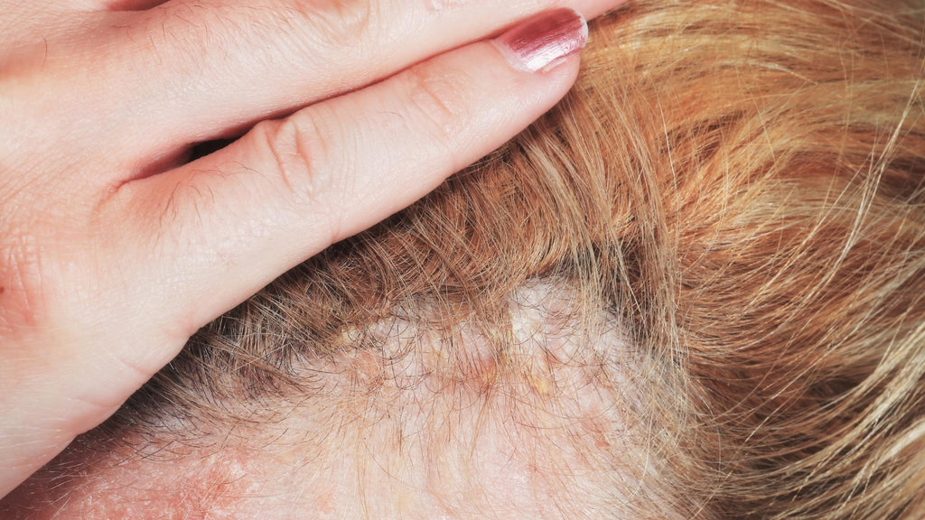 scalp psoriasis