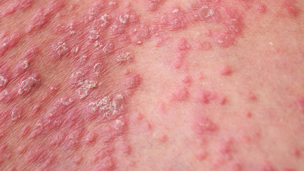 guttate psoriasis