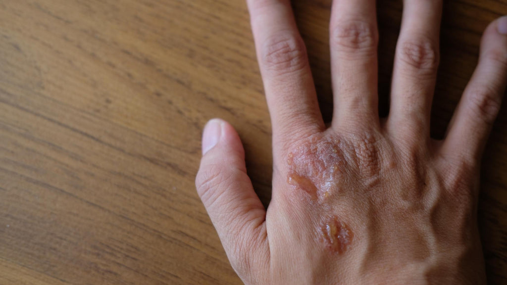 pustular psoriasis