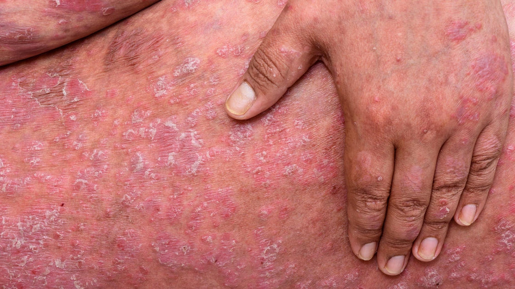 erythrodermic psoriasis