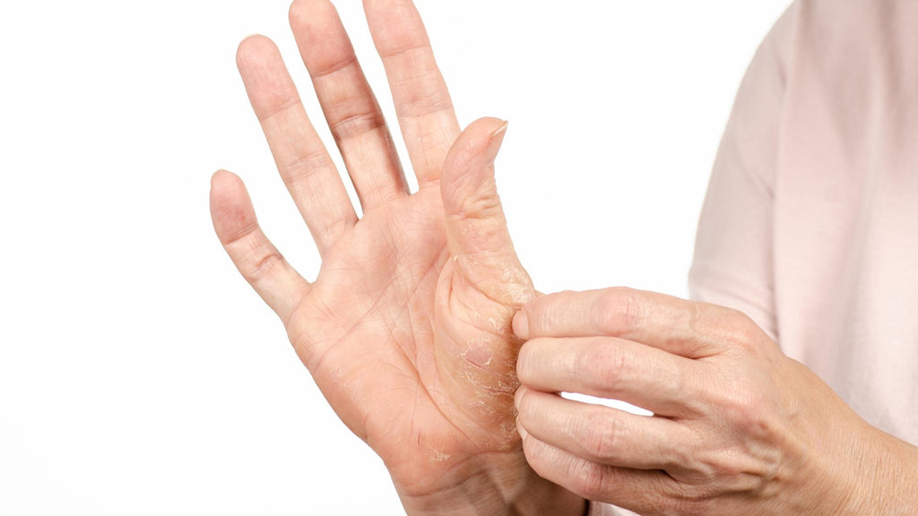 psoriasis of hand