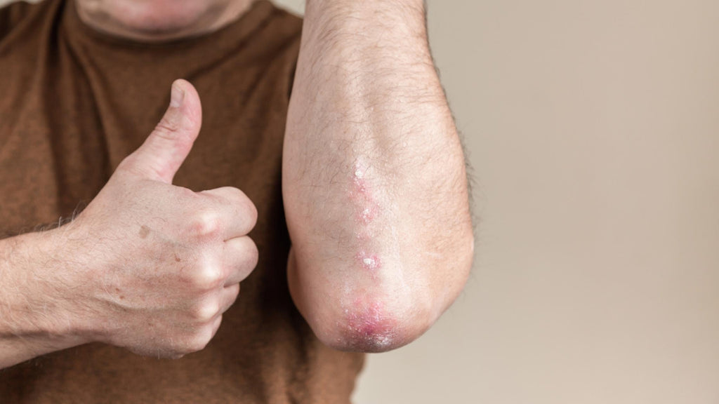 PSORIASIS WHAT WORKS WHAT DOESN'T WORK