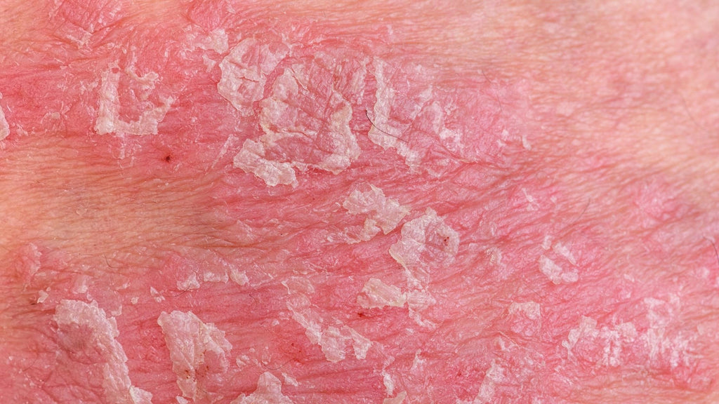 psoriasis and skin