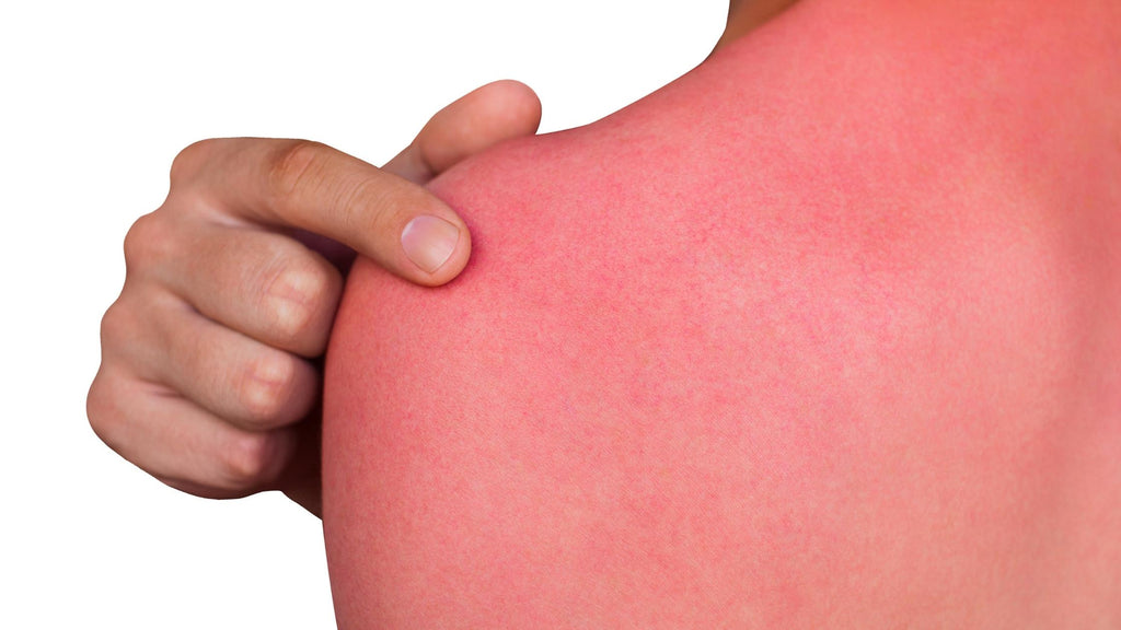 psoriasis and sunburns