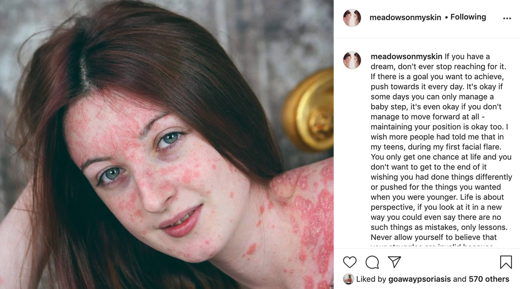 @meadowsonmyskin & psoriasis