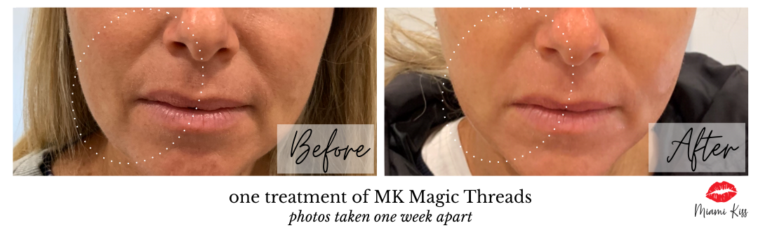 Miami Kiss Magic Threads - face definition treatment before and after one treatment