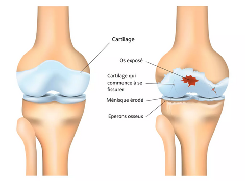 Déchirure du cartilage du genou 