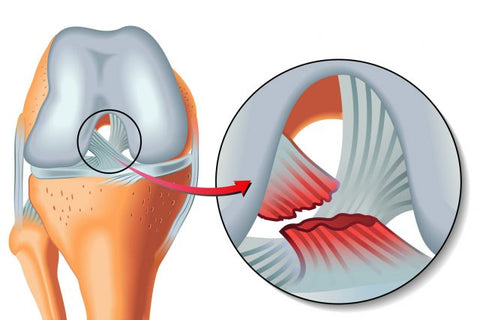 Déchirure du ligament du genou