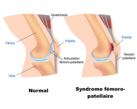 Syndrome de douleur fémoro-patellaire (SFP)