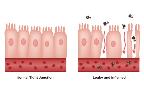 normal tight junctions vs leaky gut tight junctions