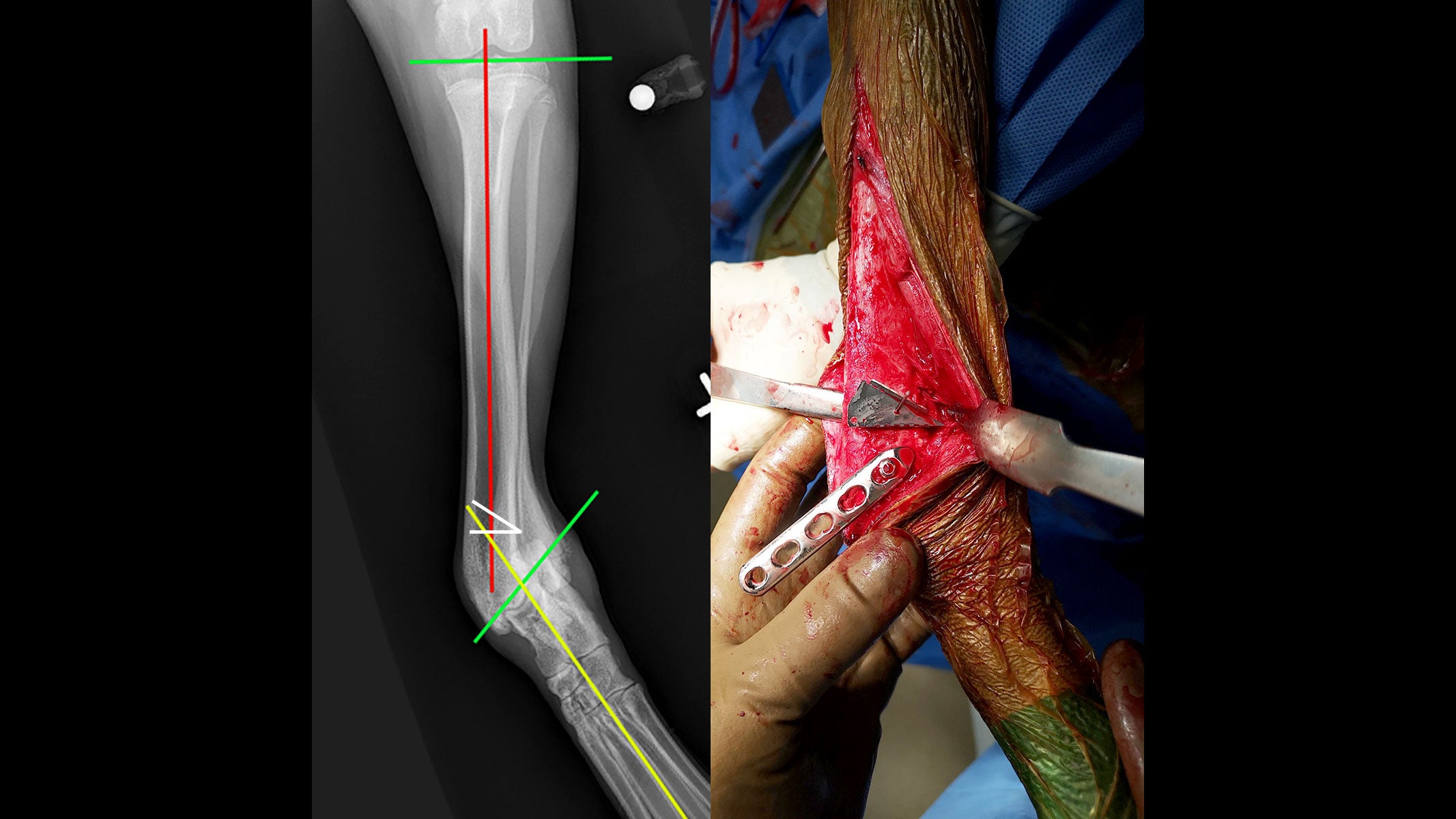 Radiograph and  gross anatomy images illustrating correction of an angular deformity
