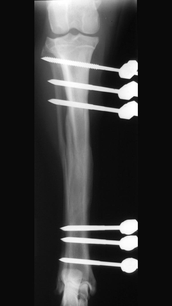 6-week radiograph demonstrating excellent fracture healing