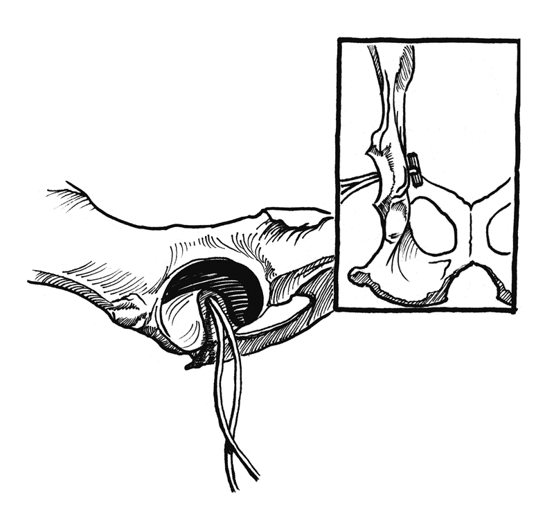 Capsulorrhaphy for Hip Luxation (Illustration)