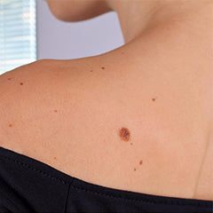 Skin Tags