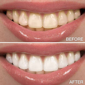 44 peroxide teeth whitening gel