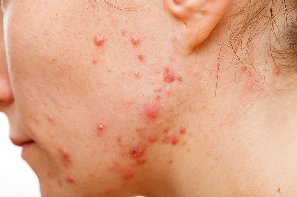 What Causes Acne Pustules How To Get Rid Of Them Derma Drink