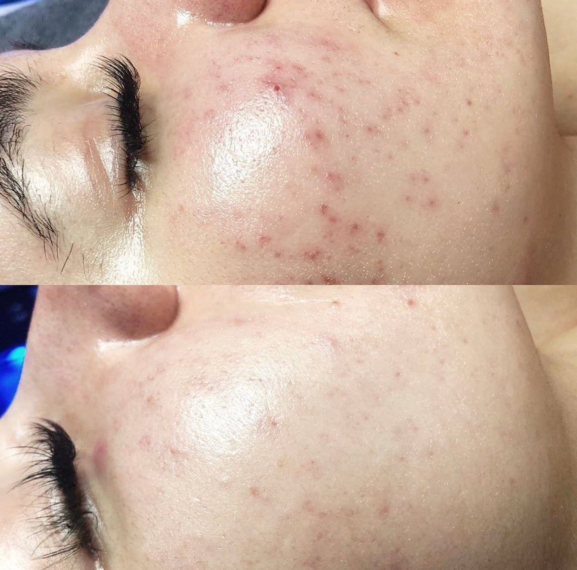 Skincare - Before/After Comparison