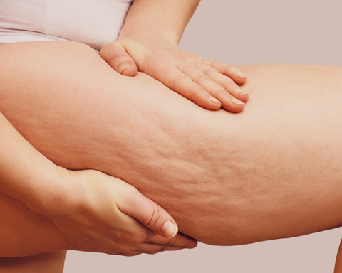 What is cellulite and what causes it