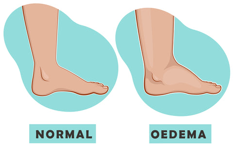 An illustration of two feet. One has the word – normal – under it, and the other is puffy and swollen and has the word – oedema – under it