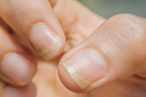 unhealthy nails signs