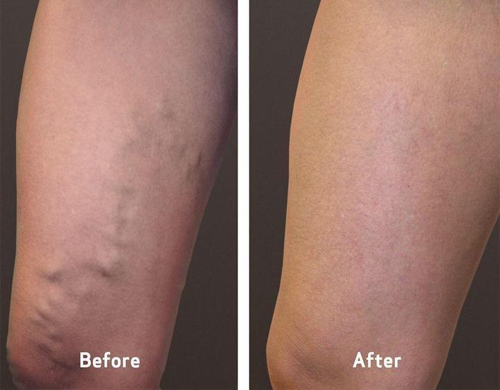 Varicose Veins Cream treatment On Sale - trendy workout