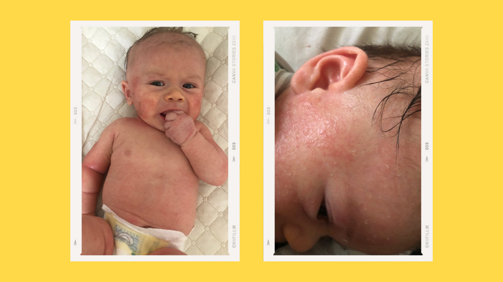 Baby with severe ezcema and rashes