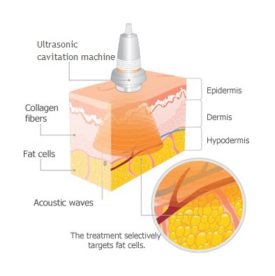 How dose 40K Cavitation Machine works