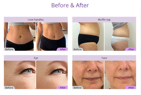cavitation before and after