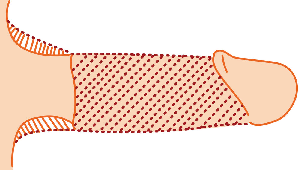 Medical Image of Penis Enlargement Surgery Results