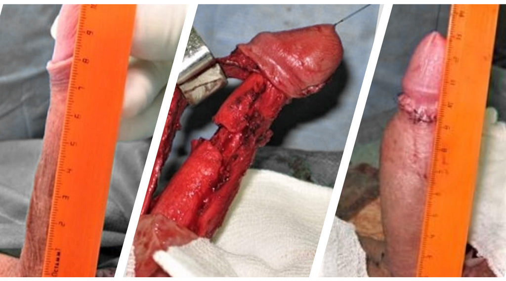 Penile Enlargement Procedure Healing: What to Expect