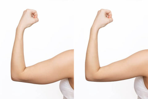 Coolsculpting Before And After Arms