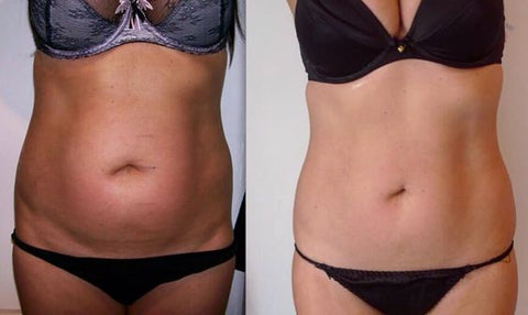 before and after using lipo laser machine