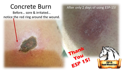 Concrete chemical burn cared for using ESP-15.