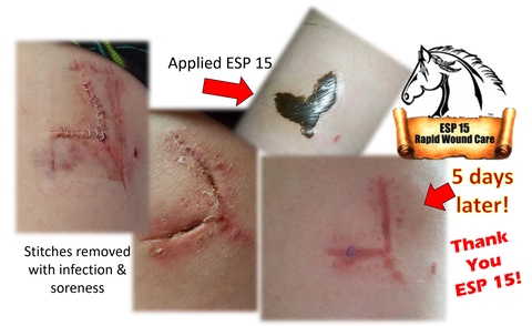 ESP-15 vs. Infected Stitches when they were removed.